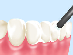 歯質を強化するフッ素塗布