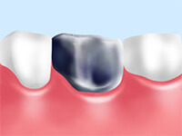 大臼歯の治療