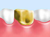 大臼歯の治療