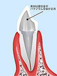 臼歯のコア（土台）