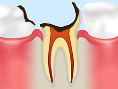 C3：神経まで達した虫歯