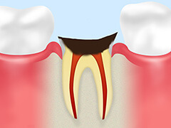 C4：末期の虫歯